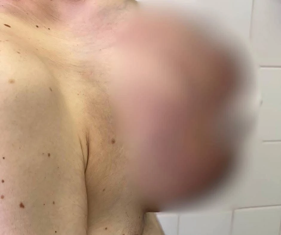 Операція на межі можливого: у Львові видалили гігантську пухлину грудної стінки